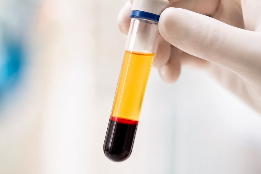 Vial of platelet-rich plasma held by a gloved hand in a clinic
